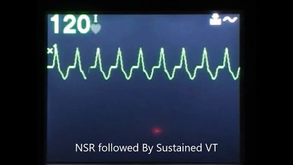 NSR converting into a Sustained VT