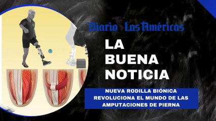 Nueva rodilla biónica revoluciona el mundo de las amputaciones de pierna | La buena noticia