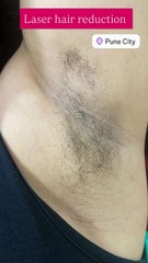 #kothrud #drrashmiaderaoclinic #skinspecialist #dermatologists #punecity #laserhair #laserhairre