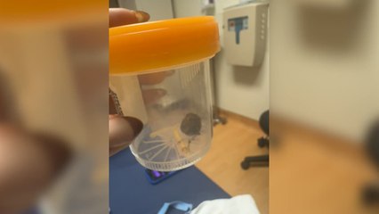 Woman Horrified as Hairball Pulled Out With Her Iud