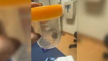 Woman Horrified as Hairball Pulled Out With Her Iud