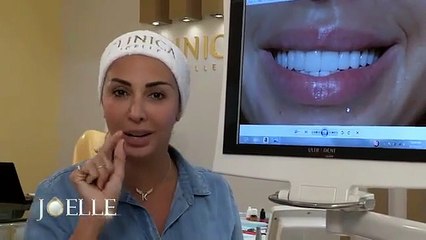 بالفيديو: هكذا تخلّصت جويل ماردينيان ممّا كانت تكرهه في وجهها