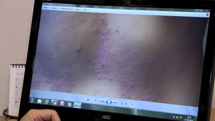 Una exposición fotográfica visibiliza el impacto del eccema crónico de manos en los pacientes