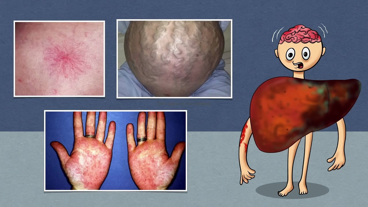 10 Skin signs of Liver Disease Fatty liver - video Dailymotion