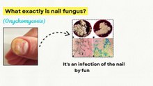 ⚠️ Your Nail Fungus Won’t Go Away Until You See This! Nail Fungus Treatment Update
