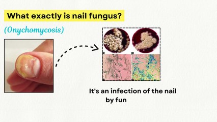 ⚠️ Your Nail Fungus Won’t Go Away Until You See This! Nail Fungus Treatment Update