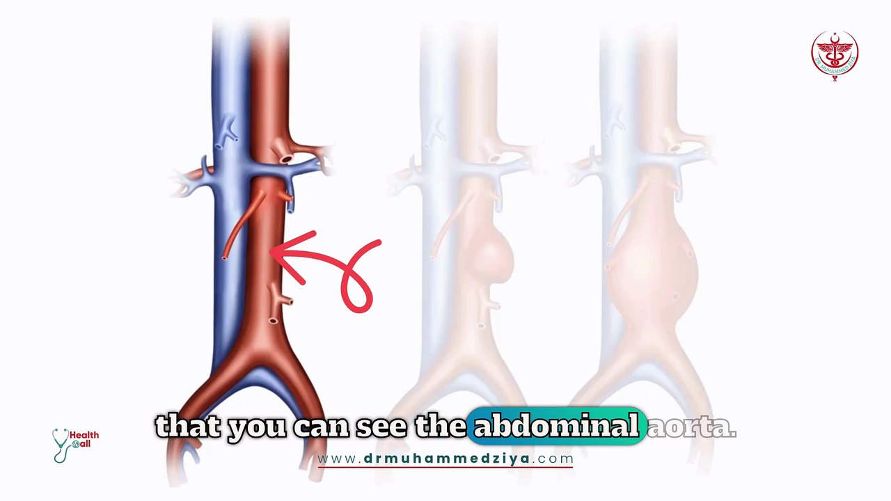 Aortic Aneurysm