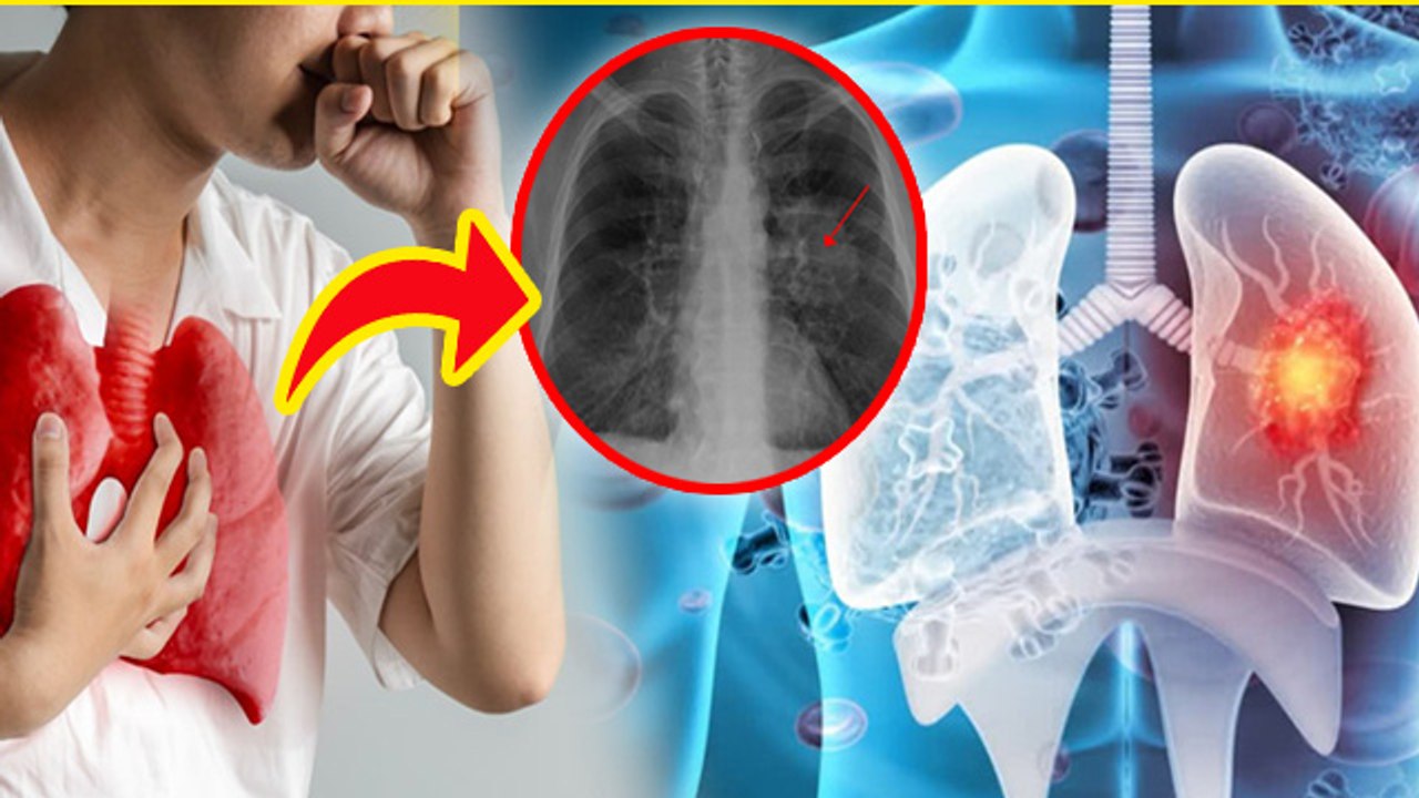 Lung Cancer Causes: लंग कैंसर होने पर क्या दिक्कतें हो सकती है, Symptoms In Hindi | Boldsky
