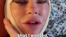 50-Year-Old's Facelift Recovery Goes Wrong 😨