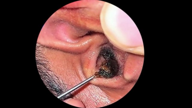Ear Wax Removal from Ear - How to cleaning ear wax 2025