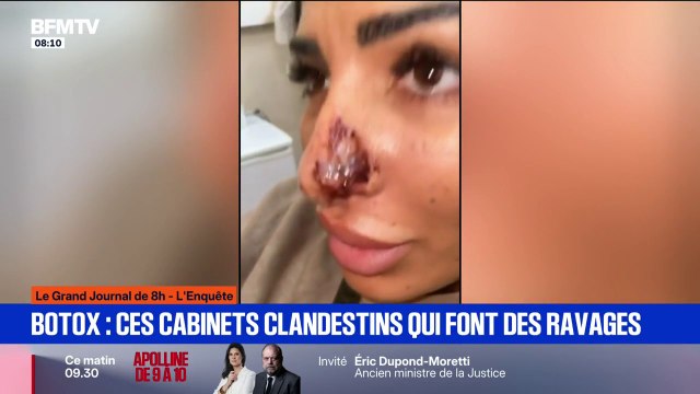 Le pus coulait : les injections illégales de botox font des ravages