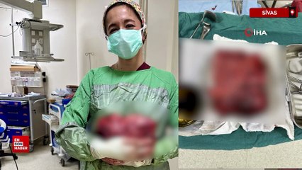 Sivas’ta nefes darlığı şikayetiyle gitti, göğsünden 3 kiloluk tümör çıkarıldı