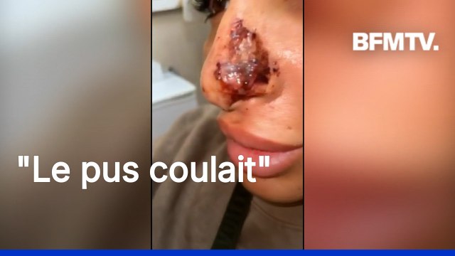Elle m'a dit que c'était l'hématome : les injections illégales de botox font des ravages