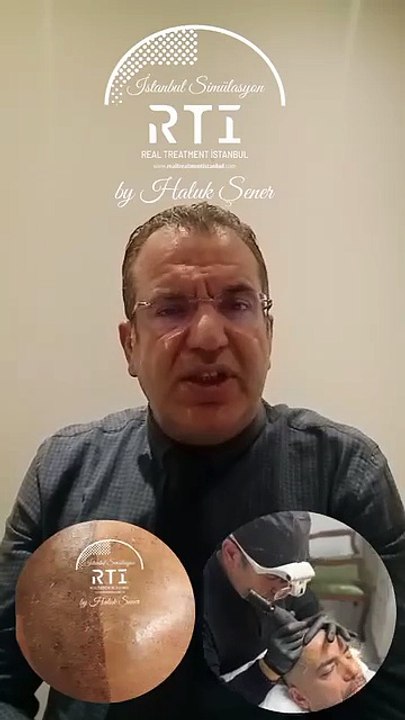 11 SAÇ SİMÜLASYONU PİGMENT BİTKİ BOYASI NEDİR? (SAÇ SİMÜLASYONU AKADEMİSİ) BY HALUK ŞENER