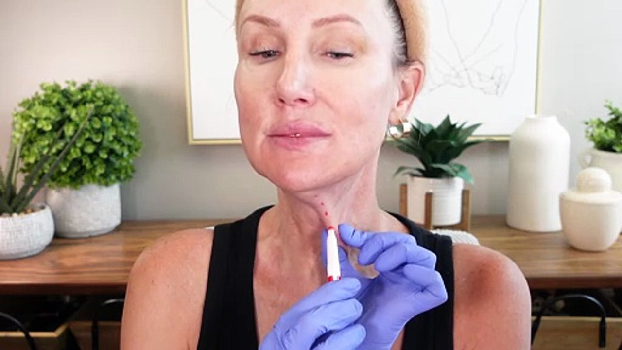 Neck Lift Demo - Dehantox 200u