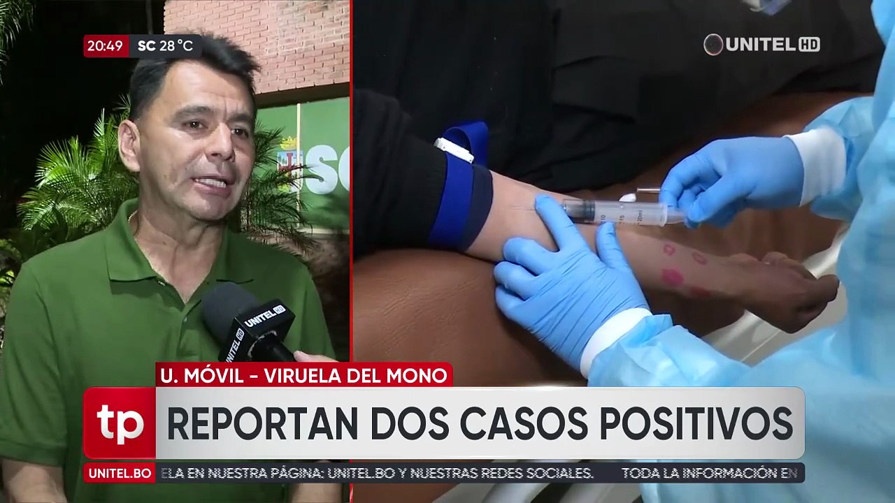 ​Sedes de Santa Cruz reporta dos casos positivos de viruela del mono y cuatro sospechosos