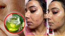 Pimples Kaise Hataye,पिंपल, मुंहासे, दाग-धब्बे से पाएं छुटकारा सिर्फ 1 दिनों मे | Homemade Cream