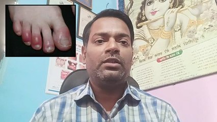 Chilblains । सर्दियों के मौसम में उंगलियों में सूजन,दर्द,जलन,खुजली,घाव को ठीक करने का इलाज ।