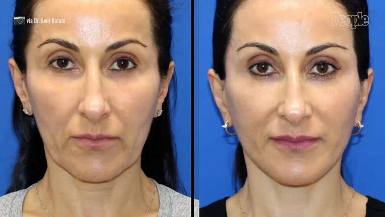 Woman, 53, Let Her Plastic Surgeon Husband Give Her a Dramatic Facelift. She Reveals the Shocking Price Tag (Exclusive)