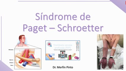 Síndrome de Paget-Schroetter #elcuerpoymas #salud #medicina #Monckeberg #SíndromePaget #PagetSchroetter
