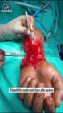 Hand Injury Surgery by Dr Ravi Saroha Plastic & Cosmetic Surgeon
