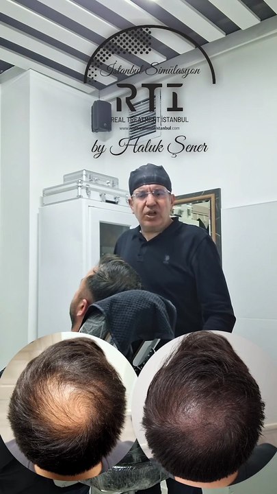 Saç Simülasyonu Tepe Bölgesi Kapatma İşlemi By Haluk Şener Telefon Aşağıda