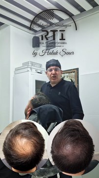 Saç Simülasyonu Tepe Bölgesi Kapatma İşlemi By Haluk Şener Telefon Aşağıda