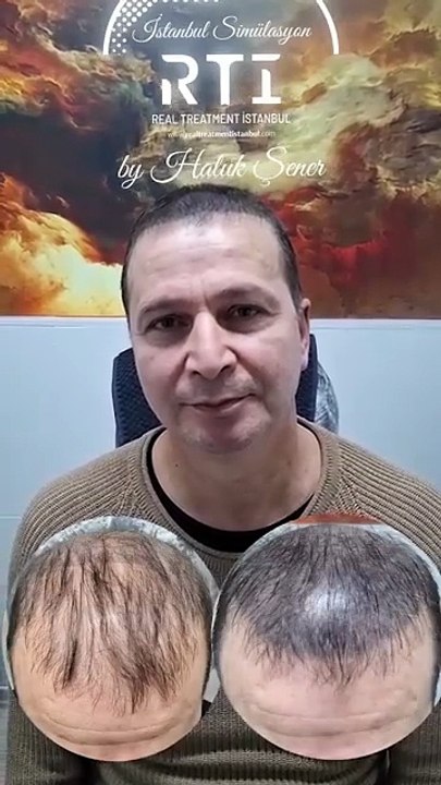 Erkan Bey Saç Simülasyonu Yaptırdı Tepe ve Ön Bölge Kapatma By Haluk Şener Telefon Aşağıda