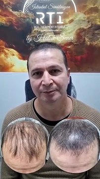 Erkan Bey Saç Simülasyonu Yaptırdı Tepe ve Ön Bölge Kapatma By Haluk Şener Telefon Aşağıda