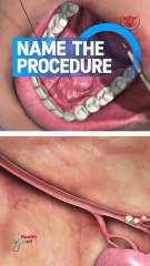 What is the name of this procedure?