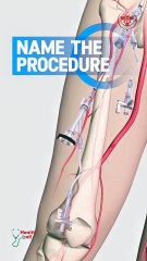 What is the name of this procedure?