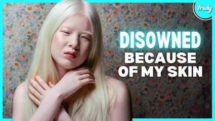 Albinism Isn’t ‘Bad Luck’ - It’s My Strength | BORN DIFFERENT