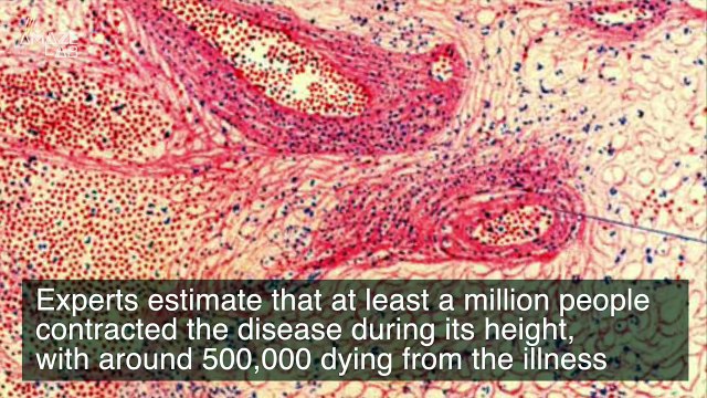 Why Did This Pandemic Left 1 Million Victims Frozen Like Statues?