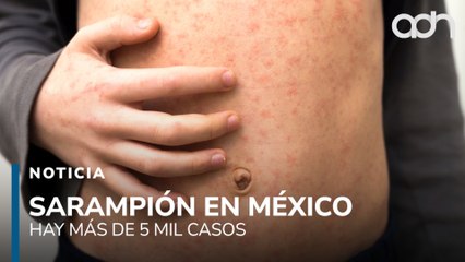 Brote de sarampión en México: más de 5 mil casos y alerta sanitaria en varias regiones