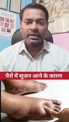 पैरों में सूजन आने के कारण ।