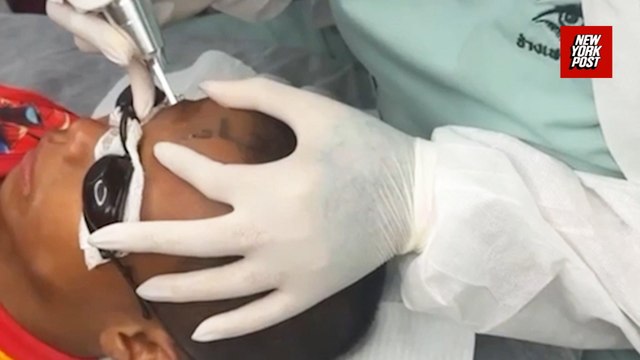 10-year-old boy has tattoo removed after bullies inked vulgar word on forehead