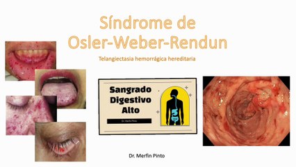 Síndrome de Osler Weber Rendun #elcuerpoymas #salud #medicina #SindromedeOslerWeberRendu #Osler-Weber-Rendu