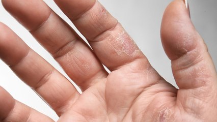 Hand Dermatitis: Causes, Conventional Treatments, and Natural Remedies