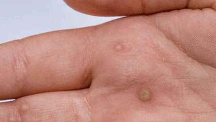 5 Types of Warts (Signs, Symptoms and Home Remedies)