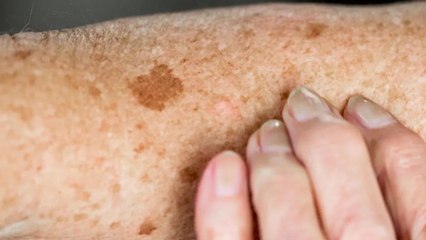 How To Reduce Age Spots: Causes, Treatment, and Prevention