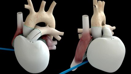 France Introduces Artificial Heart That Could Last A Lifetime Without Donors
