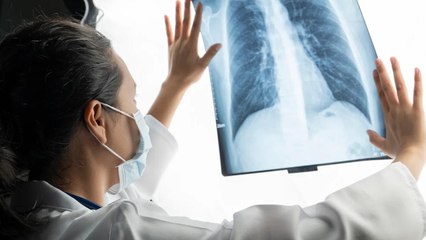 He Never Smoked, But Still Got Lung Cancer at 45. Here’s the One Symptom He Noticed