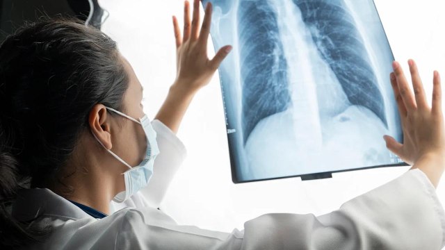 He Never Smoked, But Still Got Lung Cancer at 45. Here’s the One Symptom He Noticed