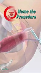 Name this procedure...