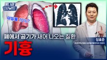 [메디컬 인사이트 108회] 흉부외과 전문의가 알려주는 '기흉의 증상과 치료법' / YTN