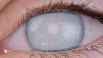 Su Salud: Cataratas