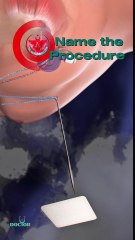 What is the name of this procedure?