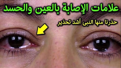 علامات العين والحسد وعلاجها