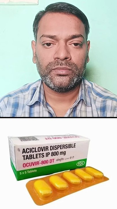 हर्पीज का इलाज ।