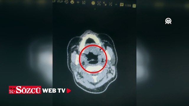 Yer: Kayseri... 27 yaşındaki kadının midesinden çıkanlar polisi şoke etti